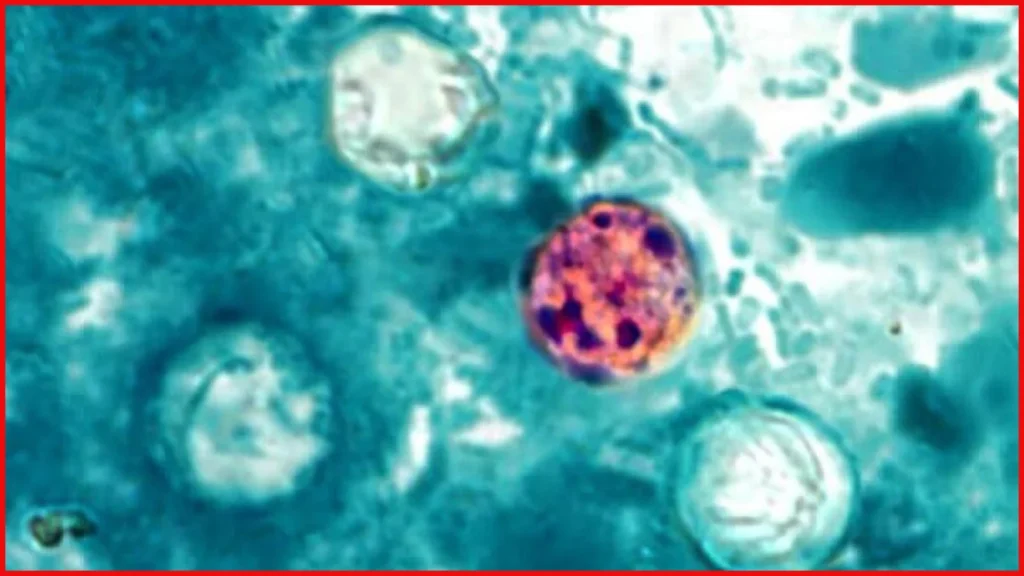 Cyclosporiasis Outbreak in US